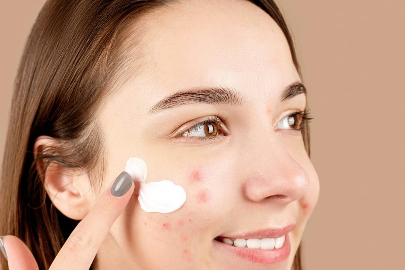 Acne: Proven Remedies That Actually Work